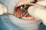 Dental implant surgery showing implant being screwed into place