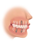 titanium dental implant face profile technical picture